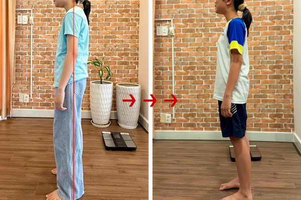 Câu chuyện chỉnh dáng của bé 14 tuổi nhưng đã cong vẹo cột sống 50 độ
