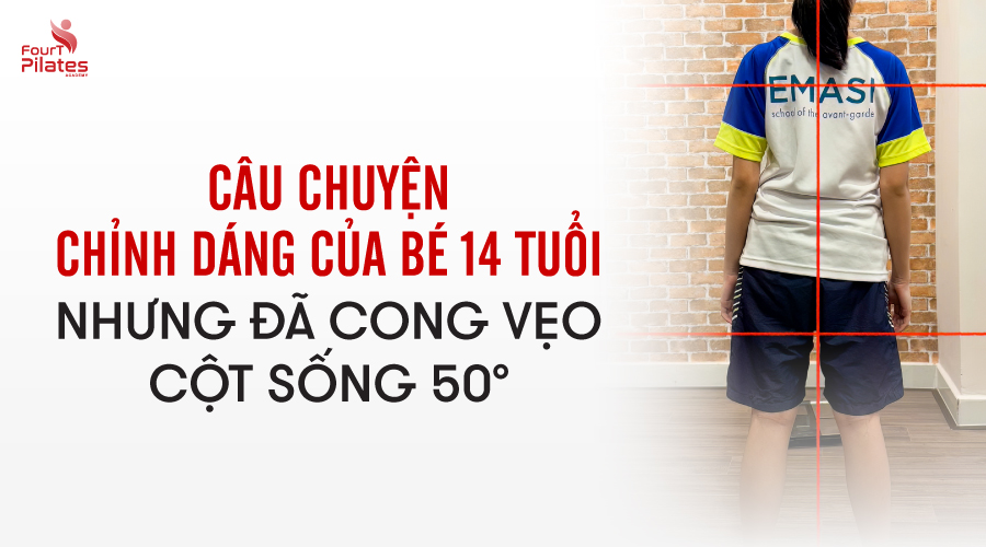 Câu chuyện chỉnh dáng của bé 14 tuổi nhưng đã cong vẹo cột sống 50 độ